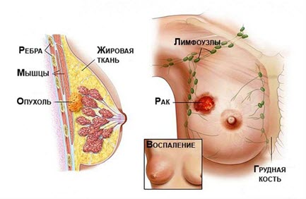 стадии рака груди